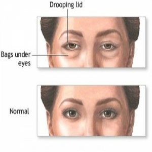 Quick fix for under eye bags? - YouTube